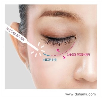 [두한성형외과 경쟁력 눈밑성형] - [눈밑 애교살을 위한 미세지방이식 ①] 관련 이미지 1