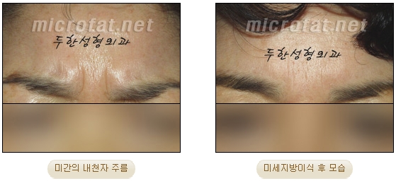 [두한성형외과 자가지방이식] - [미간주름] 관련 이미지 10