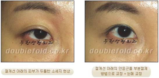 두한성형외과 쌍커풀 재수술 - 눈매교정 재수술 관련 이미지 74