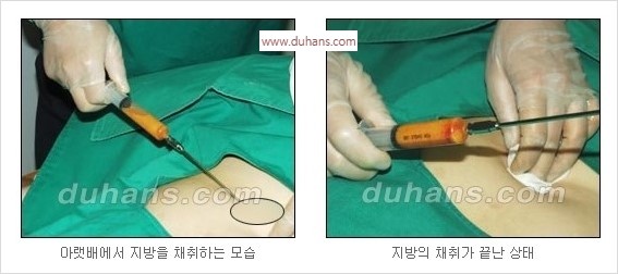 [두한성형외과 경쟁력 동안성형 리더] - ​[미간주름, 이마주름, 안검성형, 이마거상술, 눈썹거상술] 관련 이미지 2