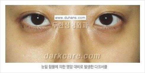 [두한성형외과 경쟁력 눈밑성형] - [다크써클의 원인과 다크써클의 종류] 관련 이미지 5