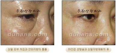 Blepharoplasty, Duhan Plastic Surgery - Upper and Lower Eyelids image 45