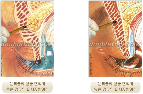 [두한성형외과 쌍커플재수술] - [함몰된 눈꺼풀의 쌍꺼풀 라인 교정] 관련 이미지 5