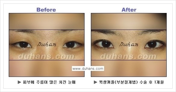 [두한성형외과 경쟁력 눈성형] - [퀵쌍꺼풀 수술 전후 정보 안내 ②] 관련 이미지 7