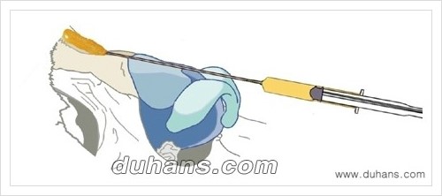 [두한성형외과 경쟁력 미세지방이식] - [자연스러운 코높임 지방이식 안내 ①] 관련 이미지 1
