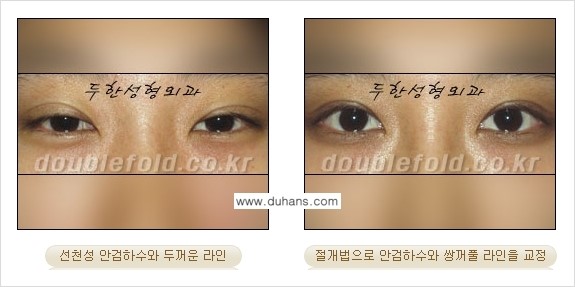 [두한성형외과 경쟁력 눈성형] - [안검하수 수술 방법] 관련 이미지 7