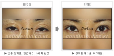 두한성형외과 쌍커풀 재수술 - 짝눈 눈매교정, 가성 안검하수 교정과 뒤밑트임 관련 이미지 44