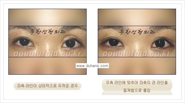 [두한성형외과 경쟁력 눈성형] - [짝짝이(비대칭) 쌍꺼풀 라인 교정하는 방법 안내 1.] 관련 이미지 8