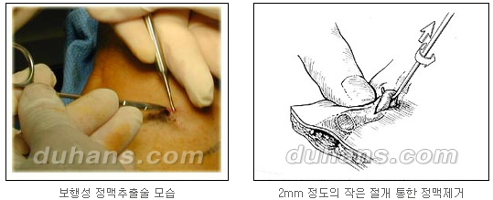 [두한성형외과 정맥류] - [정맥류 시술안내] 관련 이미지 7