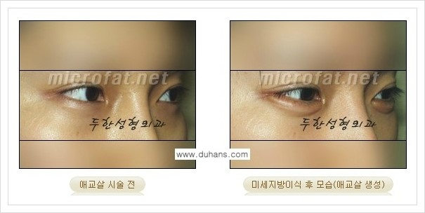 [두한성형외과 경쟁력 눈밑성형] - [애교살과 다크써클과의 관계] 관련 이미지 19