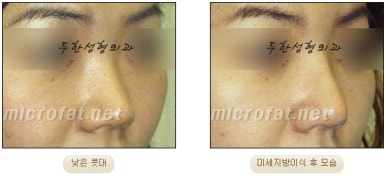 [Duhan Plastic Surgery Facial Fat Grafting] - [Fat Grafting Rhinoplasty] image 15