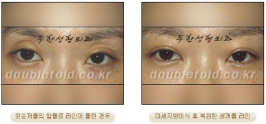 [두한성형외과 눈성형] - [풀린 쌍커풀 재수술] 관련 이미지 14