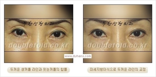 [두한성형외과 경쟁력 눈성형] - [쌍꺼풀 재수술 과정과 쌍꺼풀 재수술 실패의 원인, 쌍꺼풀 재수술의 성공 요건] 관련 이미지 38