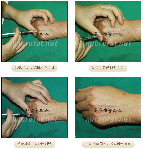 [Duhan Plastic Surgery Clinic Varicose Veins] - [Hand and Arm Venous Dilation] image 4