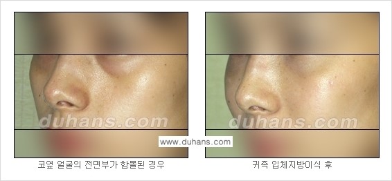 ​​​⁠[두한성형외과 경쟁력 미세지방이식] - [귀족수술 - 입체미세지방이식 ②] 관련 이미지 9