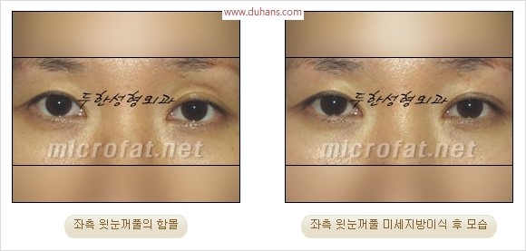 [두한성형외과 경쟁력 눈성형 리더] - [윗눈꺼풀 함몰( #꺼진눈꺼풀) 미세지방이식과 상안검성형]#꺼진눈성형 , #눈위함몰 관련 이미지 22