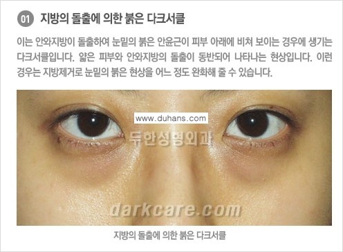 [두한성형외과 NO.1 경쟁력] - [원인과 색에 따른 다크써클의 종류] 관련 이미지 2