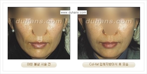 [두한성형외과 경쟁력 미세지방이식] - [지방이식 특허 Col-fat 미세지방이식 성공사례 안내] 관련 이미지 16