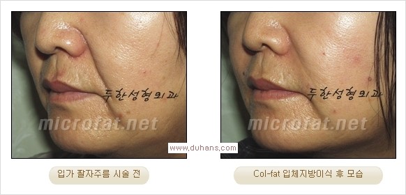 [두한성형외과 경쟁력 지방이식] - [두한 자가지방이식 클리닉 안내]​ 관련 이미지 48