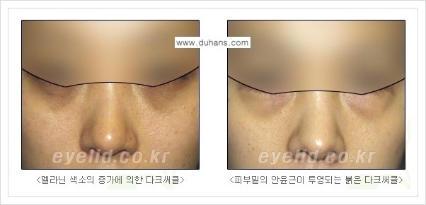 [두한성형외과 경쟁력 눈밑성형] - [다크써클 수술 안내 1.] 관련 이미지 2
