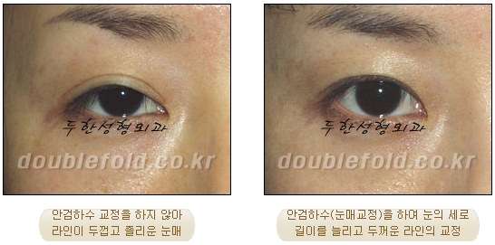 [두한성형외과 쌍수] - [재수술 실패의 원인, 재수술의 성공 요건] 관련 이미지 11