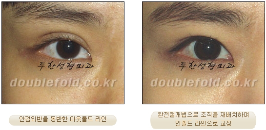 두한성형외과 쌍커풀 재수술 - 눈매교정 재수술 관련 이미지 63
