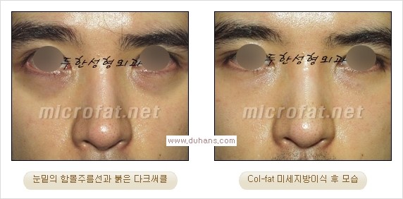 [두한성형외과 경쟁력 눈밑성형] - [눈밑이 전반적으로 함몰된 다크써클 교정 안내] 관련 이미지 12