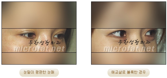 [두한성형외과 지방이식] - [다크서클, 눈밑주름] 관련 이미지 50