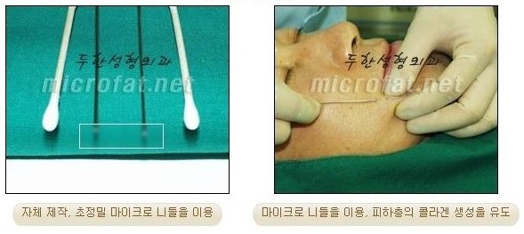 [두한성형외과 자가지방이식] - [3차원 미세지방이식] 관련 이미지 9