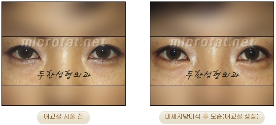 ​[두한성형외과 지방이식] - [애교살] 관련 이미지 8