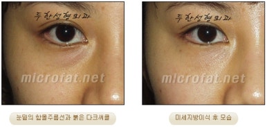 Fat Grafting Leader Duhan Plastic Surgery - Everything About Fat Grafting image 43