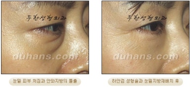 Blepharoplasty, Duhan Plastic Surgery - Upper and Lower Eyelids image 44