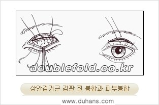 [두한성형외과 경쟁력 눈성형] - [안검하수 수술 방법] 관련 이미지 6