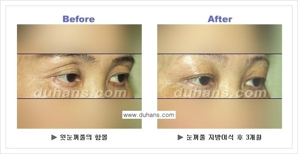 [두한성형외과 경쟁력 눈성형] - [상큼하고 환한 젊은 눈매 상안검성형(윗눈꺼풀 처짐) 안내] 관련 이미지 7
