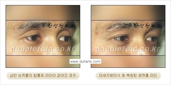[두한성형외과 경쟁력 눈성형] - [미세지방이식으로 풀린 라인의 교정 방법 안내] 관련 이미지 8