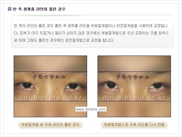 [두한성형외과 경쟁력 쌍꺼풀 재수술] - [짝짝이(비대칭) 쌍꺼풀 라인 교정하는 방법 안내 2.] 관련 이미지 1