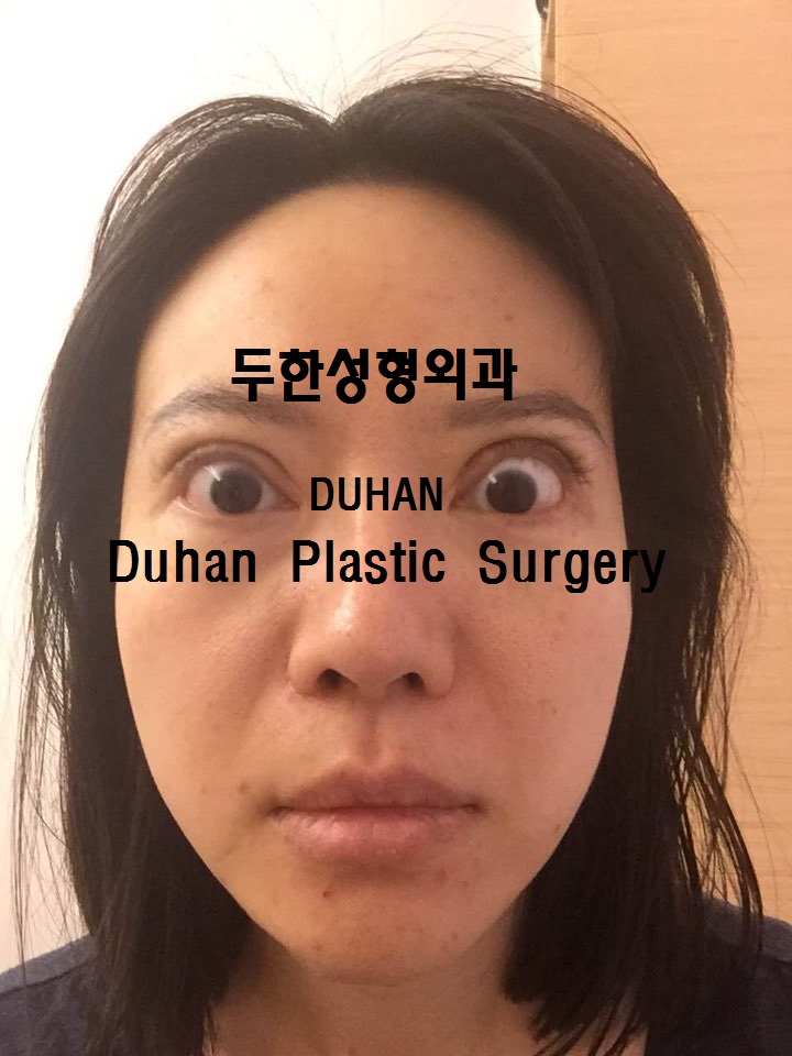 #극한눈재수술  #쌍꺼풀재수술 #눈수술입니다. #외반교정 #안검퇴축 관련 이미지 1