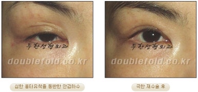 쌍꺼풀수술 두한성형외과 - 쌍커풀재수술의 문제점 관련 이미지 28