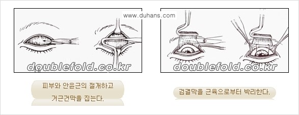 [두한성형외과 경쟁력 눈성형] - [안검하수 수술 방법] 관련 이미지 4