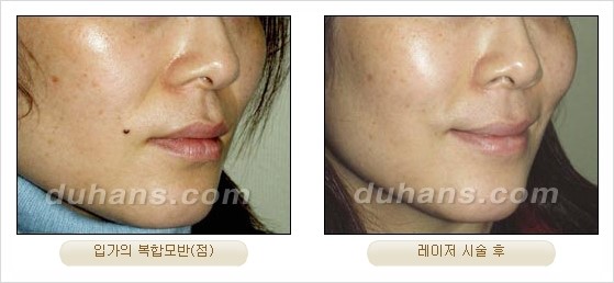 [두한성형외과 경쟁력 안전성형] - [최첨단 장비를 이용한 흉터, 점, 주근깨, 잡티, 문신제거 레이저 시술] 관련 이미지 23