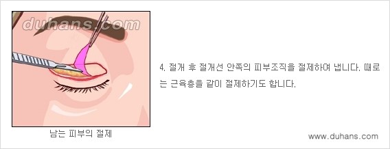 [두한성형외과 성형 FOCUS] - [젊고 환한 눈매 상안검성형 안내] 관련 이미지 5
