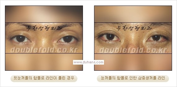 ​⁠⁠[두한성형외과 경쟁력 쌍꺼풀 재수술, 극한 눈재수술] - [지방이식으로 눈매와 쌍꺼풀 라인을 교정] 관련 이미지 2