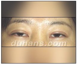 Candidates for Double Eyelid Revision Surgery: Unattractive Double Eyelids, Beautiful Double Eyelids image 7