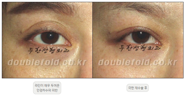 [Duhan Plastic Surgery Double Eyelid Revision] - [Thick Double Eyelid Line] image 57