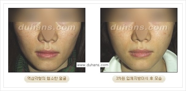 [두한성형외과 경쟁력 얼굴미세지방이식] - [볼살지방이식, 이마지방이식, 측두부지방이식 안내] 관련 이미지 9