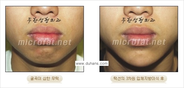 [두한성형외과의 경쟁력 미세지방이식] - [무턱교정 - 턱 미세지방이식 안내 2.] 관련 이미지 15