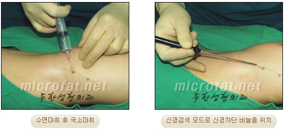 [Duhan Plastic Surgery Clinic Calf Contouring] - [Calf Reduction] image 9