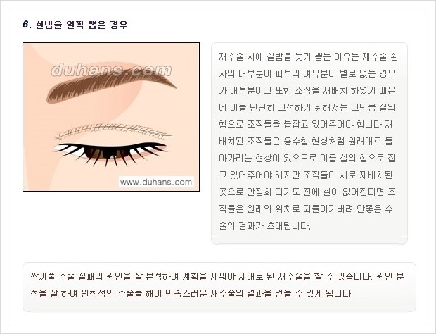 ​​[두한성형외과 경쟁력 쌍꺼풀(눈) 재수술] - [쌍꺼풀(눈) 재수술 실패의 원인 분석 안내] 관련 이미지 8