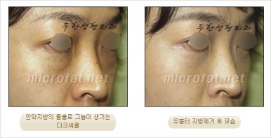 두한성형외과 눈밑수술 - 다크서클 수술 전후 관리 안내 관련 이미지 42