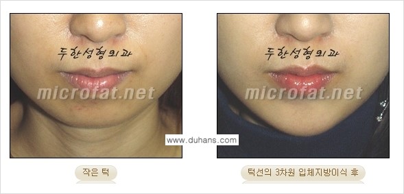 [두한성형외과의 경쟁력 미세지방이식] - [무턱교정 - 턱 미세지방이식 안내 2.] 관련 이미지 19